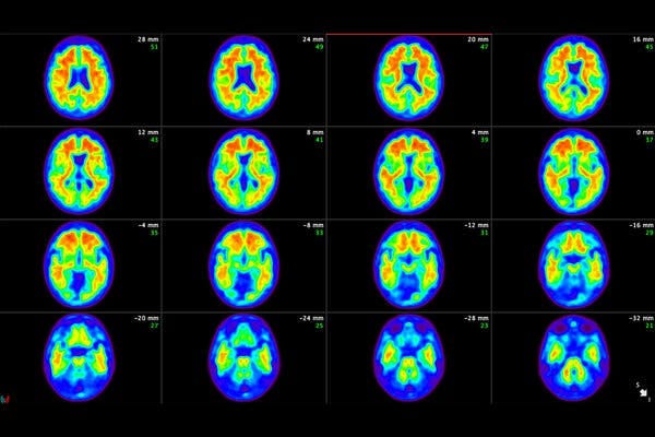 Rows of PET scans of a human brain against a black background.