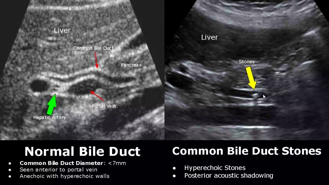 Bile Duct Ultrasound Normal Vs Abnormal Image Appearances | Biliary Tract Abnormalities USG Scan Bile Duct Ultrasound Normal Vs Abnormal Image Appearances | Biliary Tract Abnormalities USG Scan