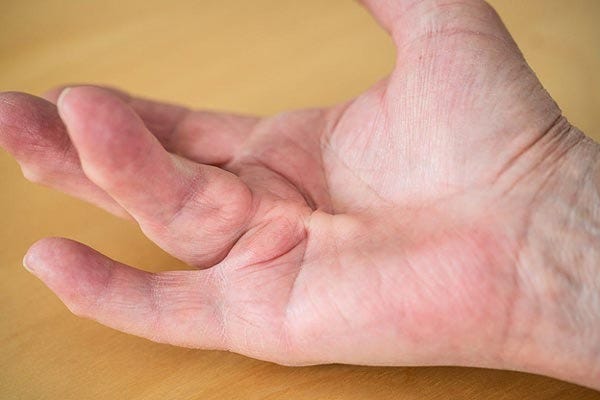 dupuytrens contracture