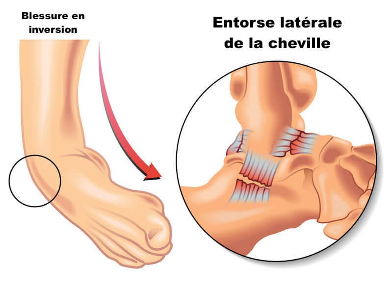 L'entorse à la cheville, comment la traiter? Traitement au laser