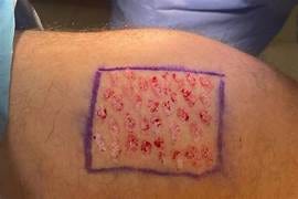 Herida crónica estancada — candidata a microinjertos en sello cuando el tratamiento convencional no avanza