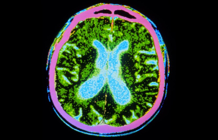Coloured CT scan of the brain of a patient suffering from Parkinson's disease.