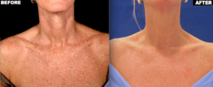 Laser Therapy For A Firmer Chest And Décolleté Laser Therapy For A Firmer Chest And Décolleté