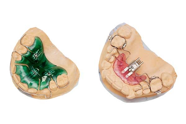 Palatal Expander Device - Newington, CT | Greater Hartford Ortho