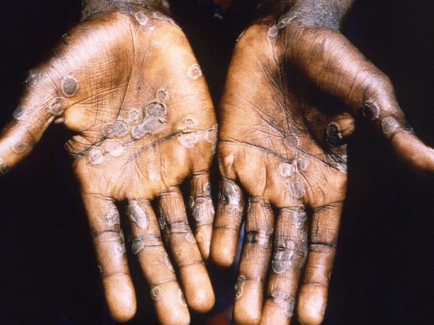 The palms of a patient with mpox during an outbreak in the Democratic Republic of Congo in 1997. The country is now seeing a dramatic spike in mpox — with a strain that is deadlier than the one that sparked the global outbreak in 2022.