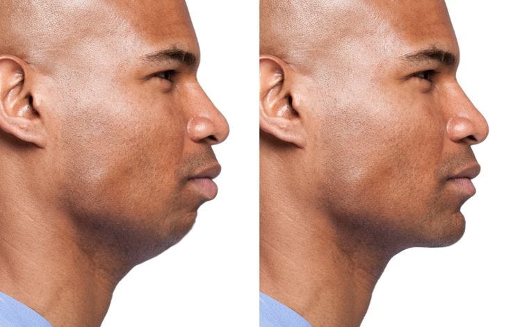Receding chin before after on a man