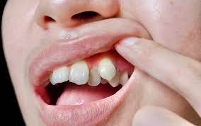 Snaggle Tooth - Causes & Treatment Options