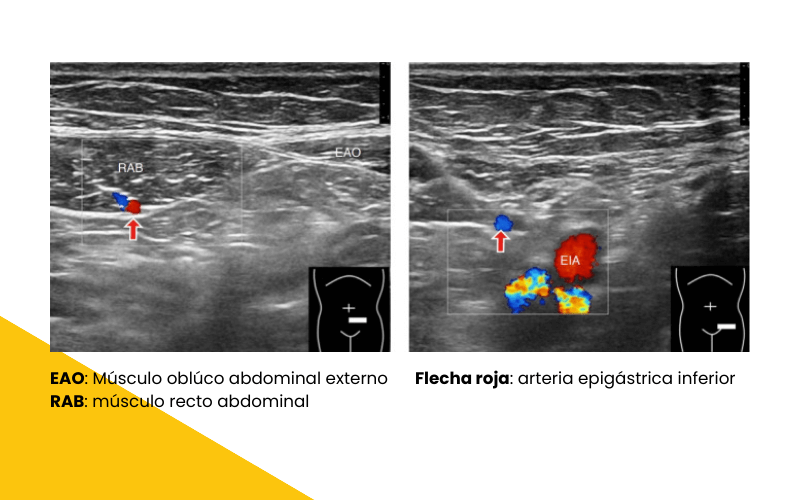2. Hernia inguinal directa ecografia tempo formacion.png