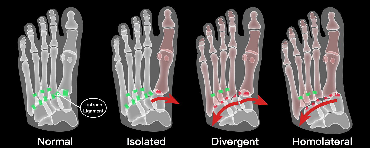 Lisfranc Injuries – EMbeds.co.uk