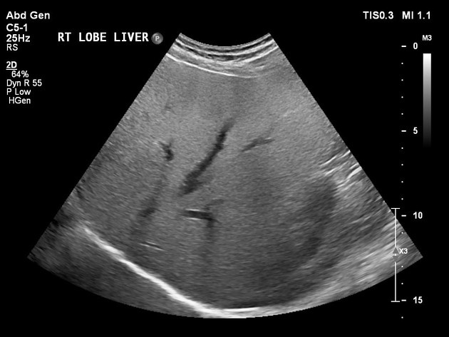 Diffuse hepatic steatosis (grading) | Radiology Reference Article | Radiopaedia.org Diffuse hepatic steatosis (grading) | Radiology Reference Article | Radiopaedia.org