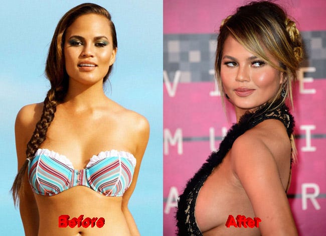 chrissy teigen plastic surgery images 2017