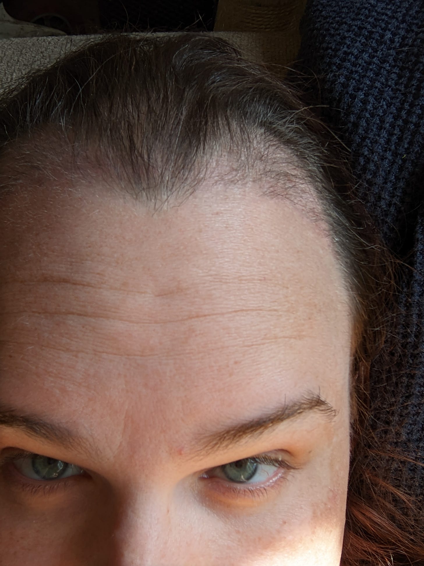 A close-up of Doc Impossible's brow and hairline at 3 months post-op. A vague tufting of hair remains in the transplanted area. Her brow is droopy, and looks a lot like it did before her FFS.