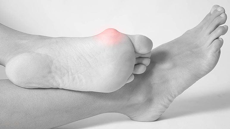 what to do about your bunions