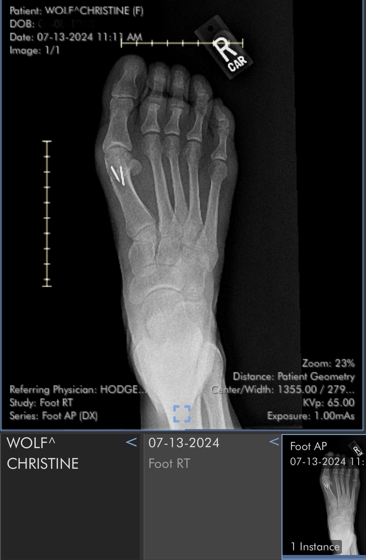 An xray of a right foot, showing 2 screws in the base of the big toe.