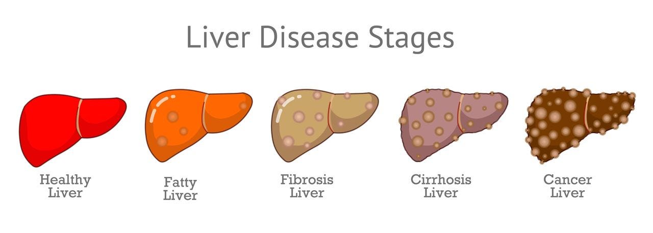 How does fatty liver disease (NAFLD) progress?