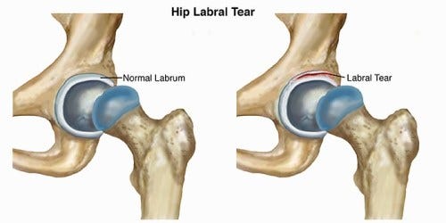 Labral Tear - Pacific Orthopedics and Sports Medicine