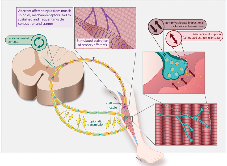 Muscle Cramps - Practical Neurology