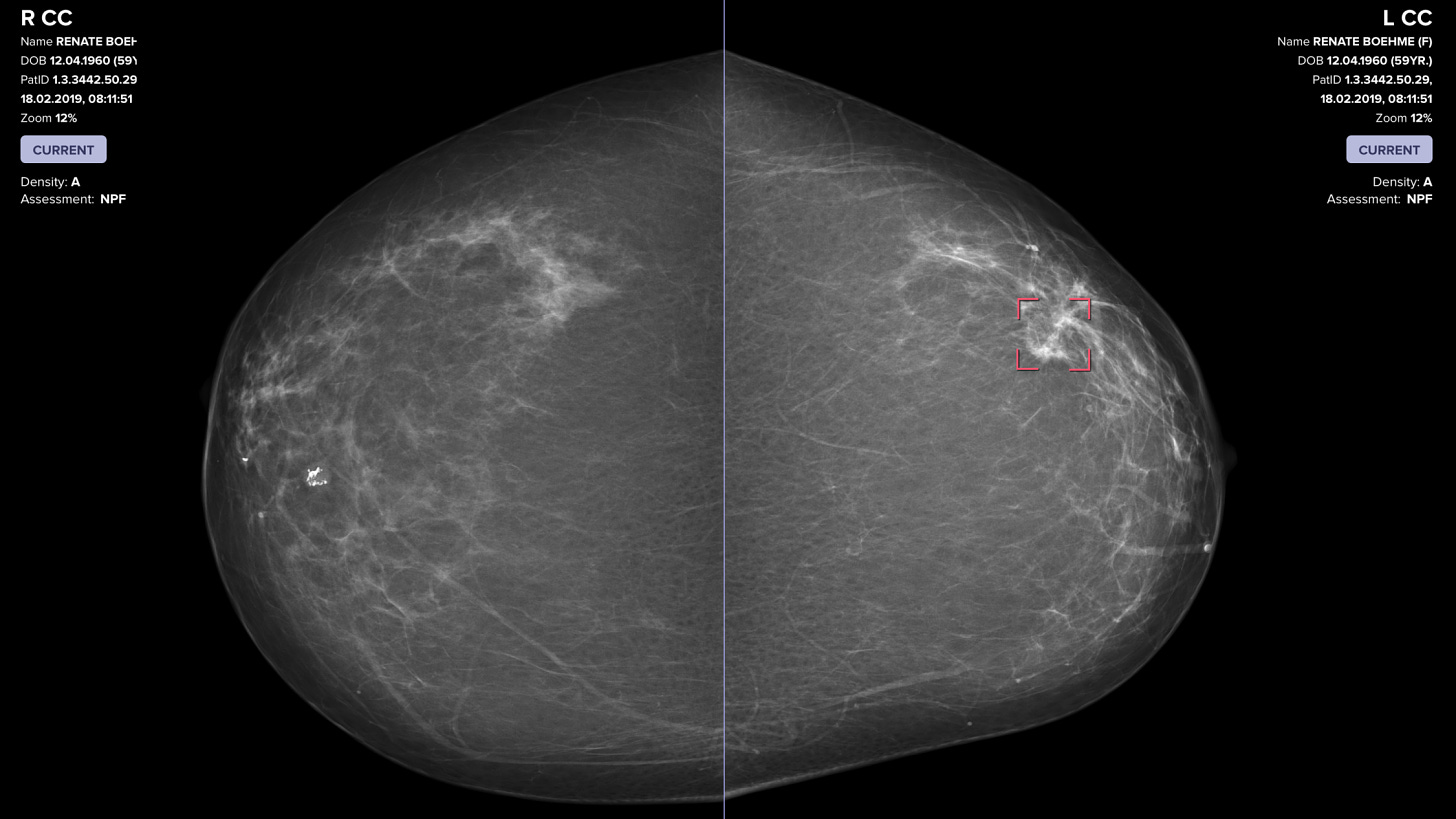 A detail from Vara's AI interface analyzing a mammogram for signs of cancer.