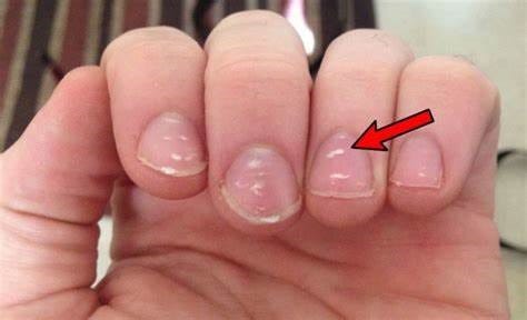 zinc deficiency noted in nails