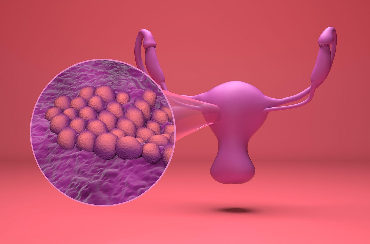 3D illustration of endometrial cancer 