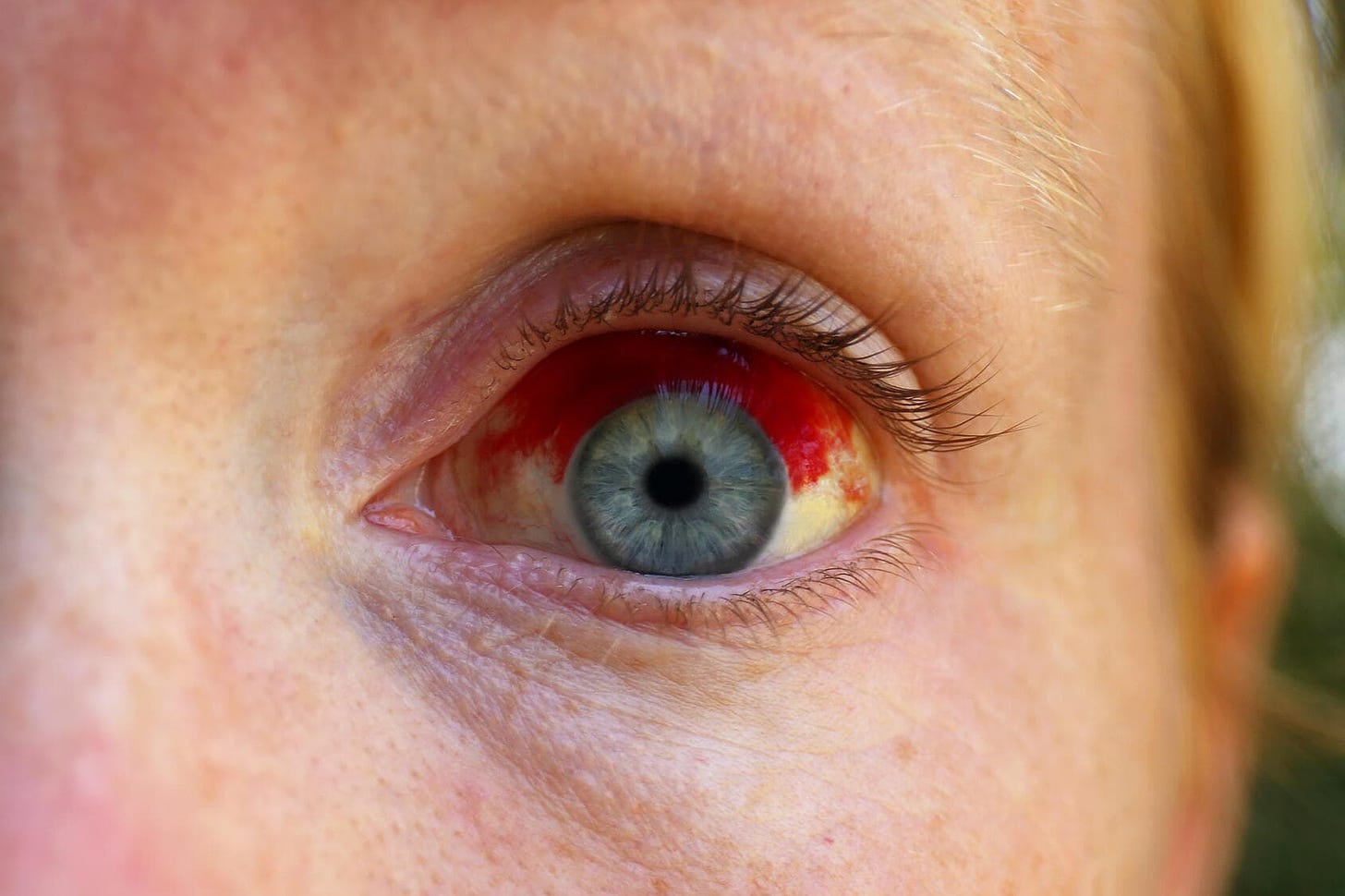 Subconjunctival hemorrhage (broken blood vessel in eye) - Symptoms & causes  - Mayo Clinic