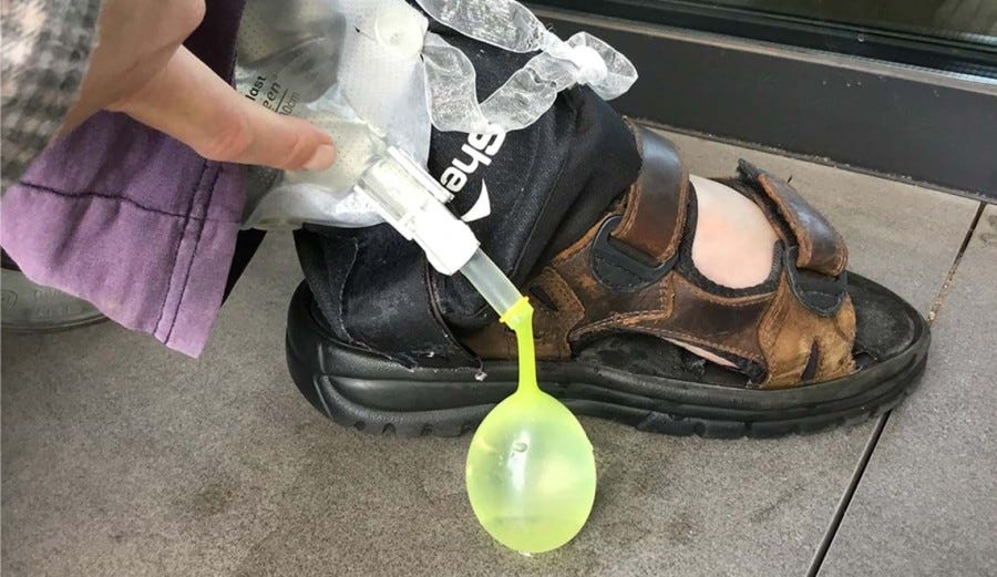 This is a close-up photo of me (Sam) releasing urine from my catheter into a yellow water balloon. I’m wearing blue pants faded to purple, a grey plaid shirt and brown leather sandals. My Dystonic hand is visible from the top left corner, pushing urine out of my catheter bag.