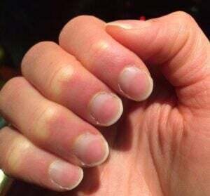 Kidney Disease and Nails: Possible Nail Symptoms