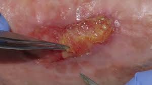 Fibrina en herida crónica