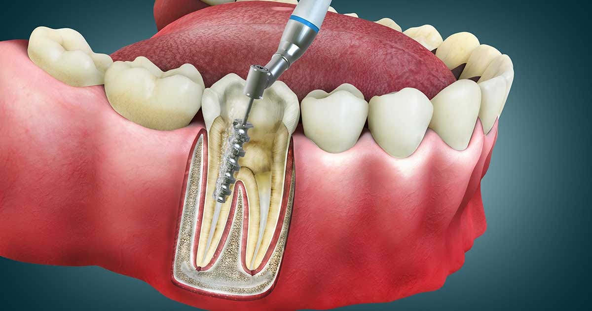 The Hidden Dangers of Root Canals – True Cellular Formulas®