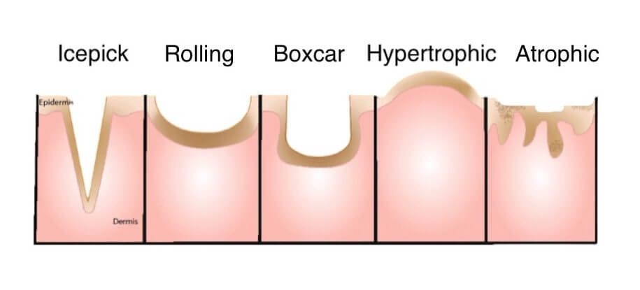 Does Retinol Help With Acne Scars?
