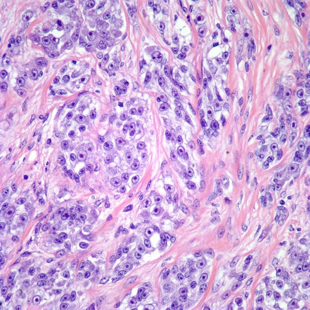 Clear Cell Sarcoma