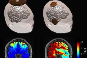 These 3D models illustrate the study's findings. The top left image shows a circular coil used for magnetic seizure therapy (MST), while the top right image shows unilateral electrode placement for electroconvulsive therapy (ECT). The bottom row displays simulated electric field distribution in the brain during stimulation for each method. Warmer colors (red) indicate stronger electric fields, while cooler colors (blue) represent weaker fields, highlighting differences in how each technique interacts with brain regions.