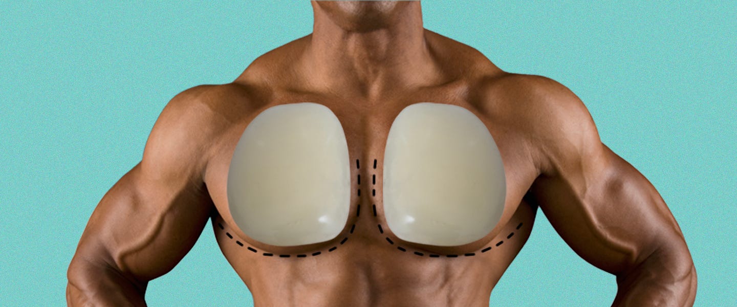 The History of Pectoral Implants for Men