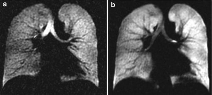 Hyperpolarised Helium-3 (3He) MRI: Physical Methods for Imaging Human Lung Function | SpringerLink Hyperpolarised Helium-3 (3He) MRI: Physical Methods for Imaging Human Lung Function | SpringerLink