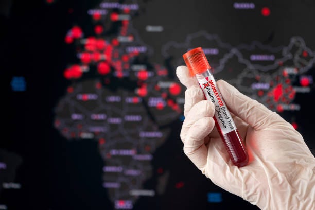 monkeypox positive blood tube and world pandemic map - monkeypox bildbanksfoton och bilder