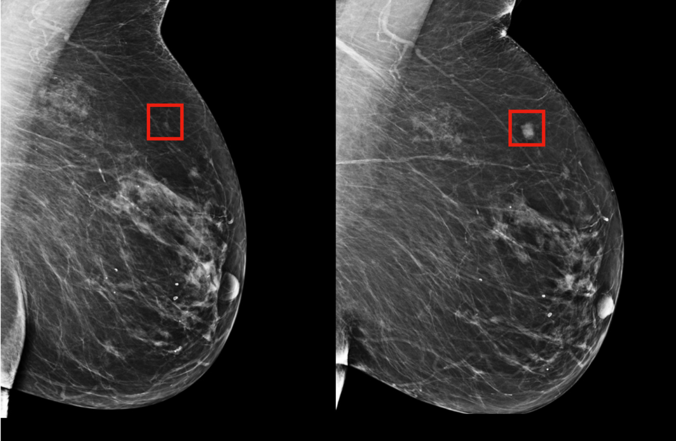 Using AI to predict breast cancer and personalize care | MIT News |  Massachusetts Institute of Technology