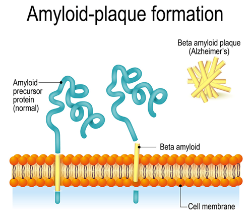 amyloid-plaque formation 