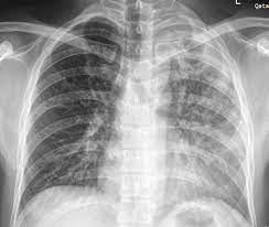 Active pulmonary tuberculosis | Radiology Case | Radiopaedia.org