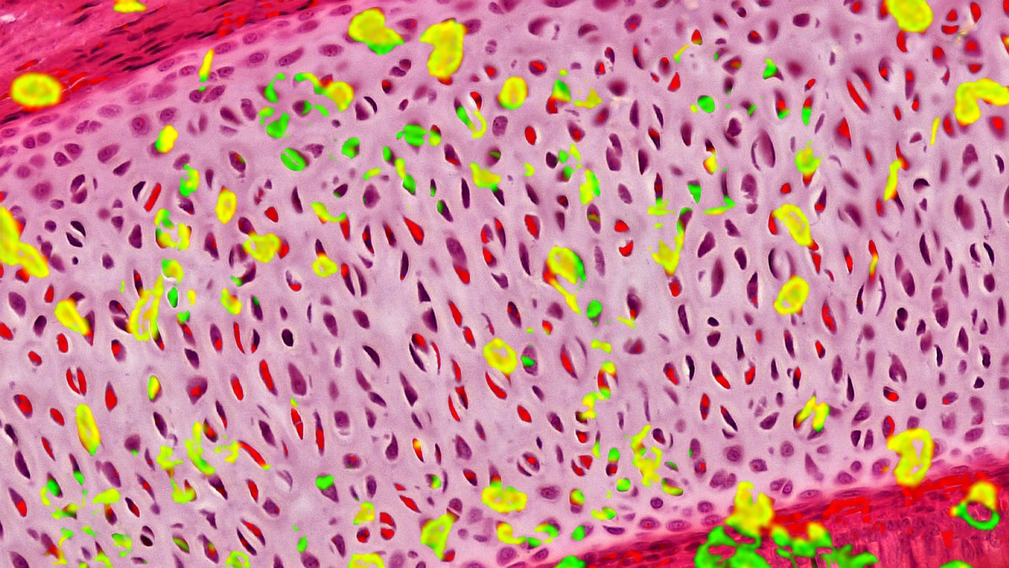 Pink cartilage tissue with abstract infiltrating chondrocytes in fluorescent yellow