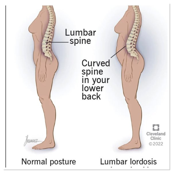 Is lumbar lordosis a normal condition, or is it a pathology? - Quora