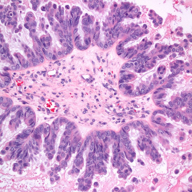 Ovarian Tumor