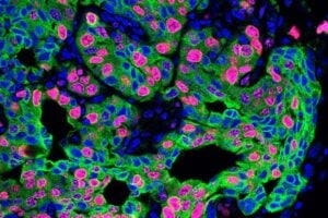 For a recent CSHL Cancer Center study, Adjunct Professor Mikala Egeblad (now a Bloomberg Distinguished Professor with Johns Hopkins University) and postdoc Xue-Yan He (now Assistant Professor of Cell Biology & Physiology at Washington University School of Medicine in St. Louis) teamed with CSHL Professor Linda Van Aelst. Above: lung cancer metastasis in a mouse that underwent experiments designed to simulate the stress that cancer patients experience.