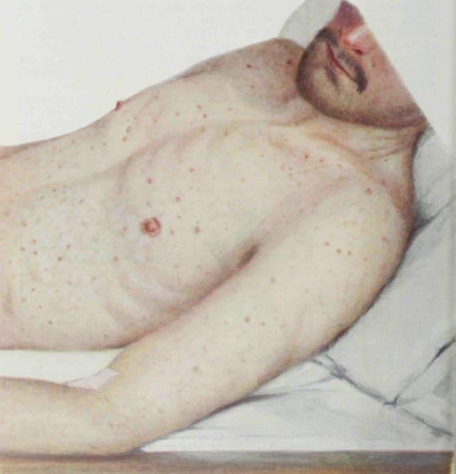 Epidemic typhus - Wikipedia