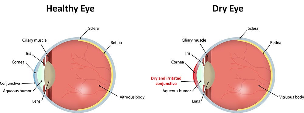 Dry Eyes Brooklyn | Dry Eye Syndrome Tribeca | New York Vision