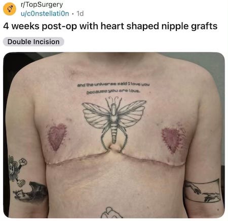 trans with mastectomy scars and nipple grafts in the shape of hearts.
