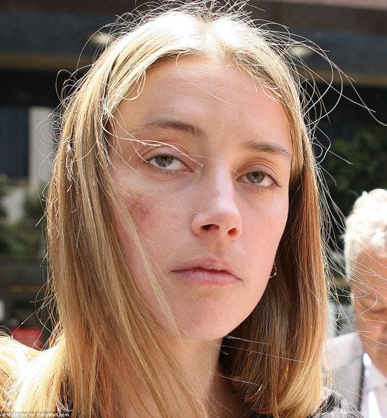 amber heard johnny depp bruising