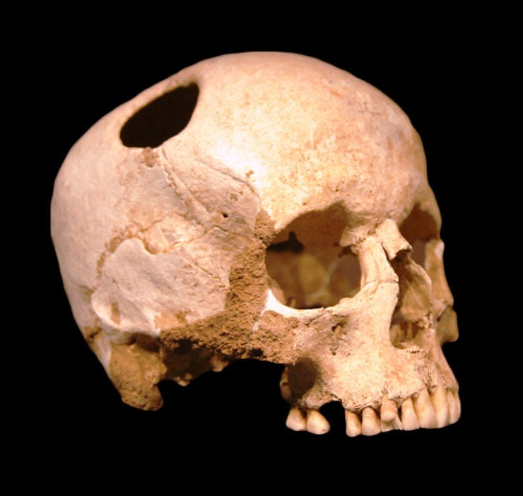Courtesy of Wikipedia. Neolithic girl's skull. The perimeter of the hole in the skull is rounded off by ingrowth of new bony tissue, indicating that the patient survived the operation.