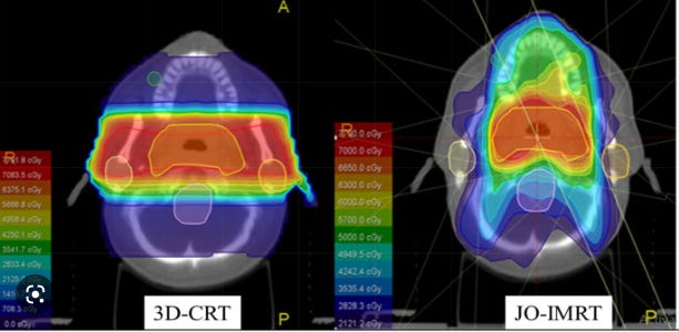 Sciencedirect 3D IMRT head and neck cancer