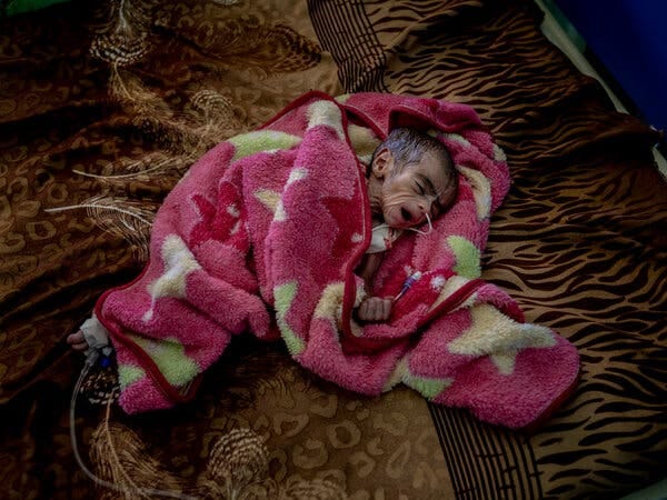 A severely malnourished infant is wrapped in a pink blanket, a feeding tube in his nose. A severely malnourished infant is wrapped in a pink blanket, a feeding tube in his nose.