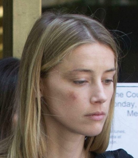 amber heard bruised face